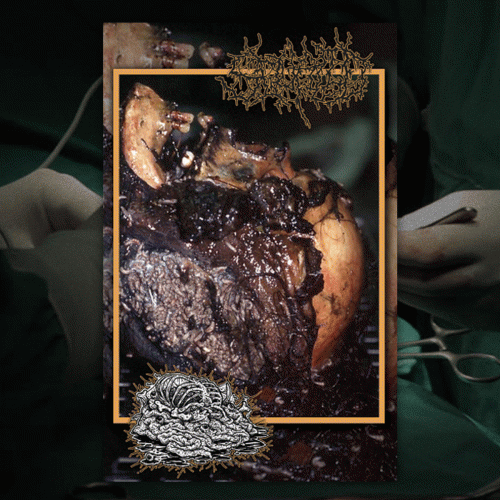 Botched Anastomosis J-Pouch : Botched Anastomosis J-Pouch - Squalid